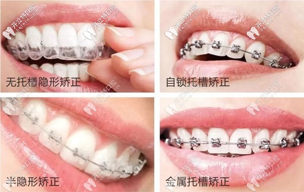 賀州微笑口腔牙齒矯正器