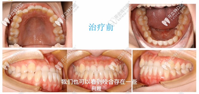 我的地包天牙齒圖 我的地包天牙齒圖