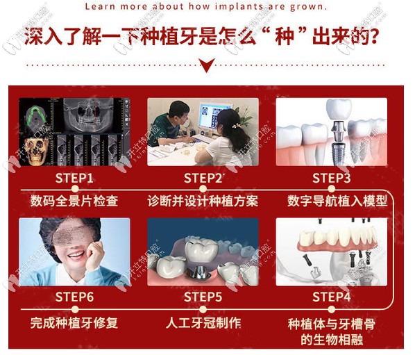 深入了解種植牙是怎么種出來(lái)的
