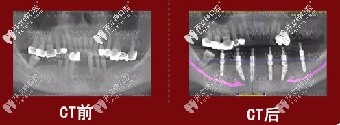 種植牙前后對(duì)比圖
