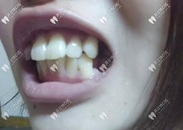 牙齒的側(cè)面照，外凸的厲害