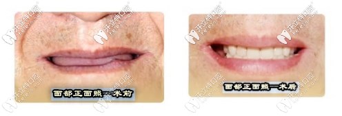 面部正面照術前術后對比