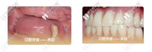我75歲沒(méi)牙去做了全口all-on-4種植牙的經(jīng)歷，種牙過(guò)程很快