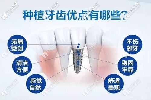 種植牙優(yōu)點