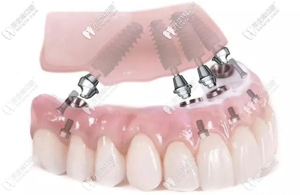 All-on-4全口種植技術及費用