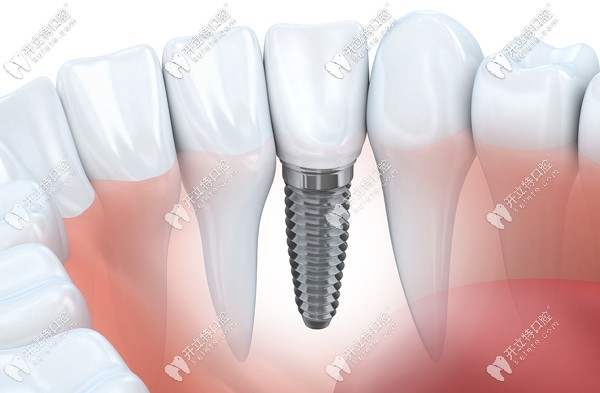 廣州全口種植牙多少錢?半固定種植4萬(wàn)元+,allon4/6種植牙9萬(wàn)元+