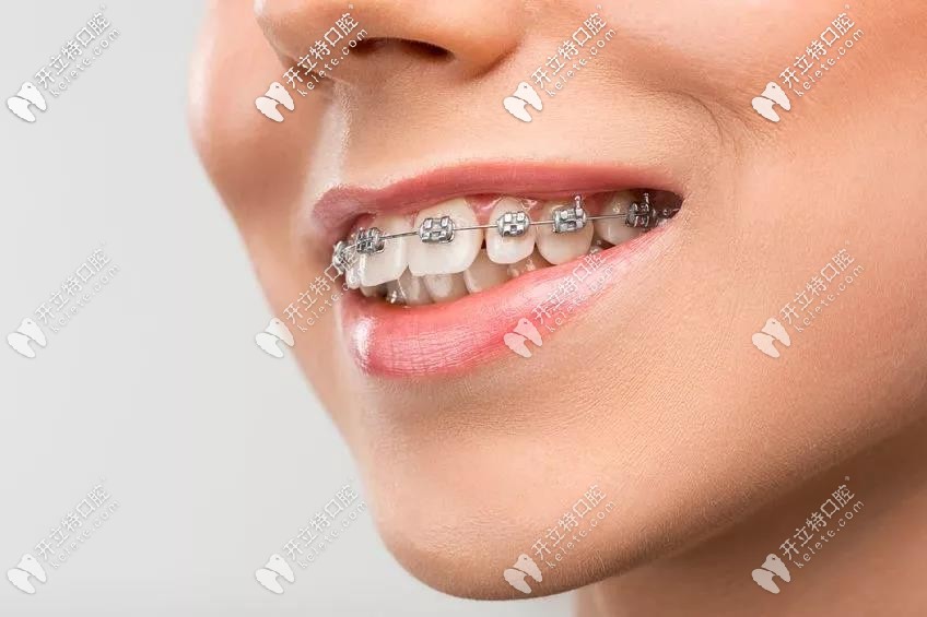 深圳美萊矯正牙齒的收費(fèi)標(biāo)準(zhǔn),并附上我戴牙箍的前后對比圖