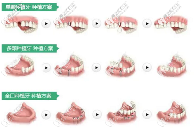 石家莊中諾口腔種植牙團(tuán)購優(yōu)惠價(jià)格活動正在進(jìn)行中