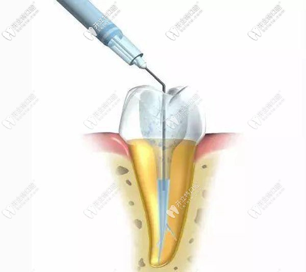 解析什么叫做根管治療 解析什么叫做根管治療