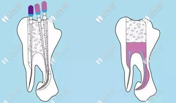 根管治療的步驟 根管治療的步驟