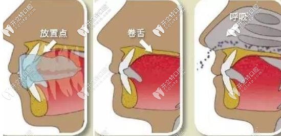 MRC的矯正放置位置 MRC的矯正放置位置
