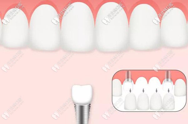 影響種植牙價格的還有種植技術(shù)