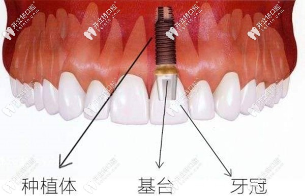 不同種植體品牌會影響一顆種植牙的價格