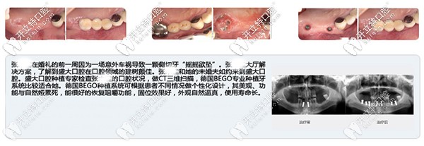 沈陽盛大口腔多顆牙缺失