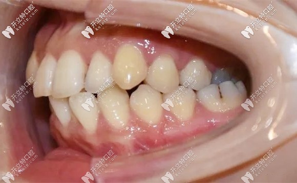 矯正前牙齒的側面樣子