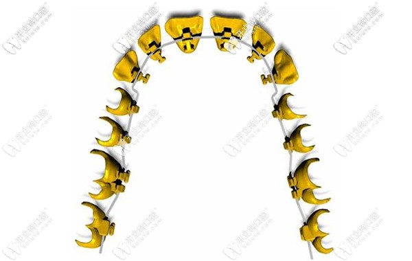 美國3M Incognito黃金舌側(cè)隱形矯治器