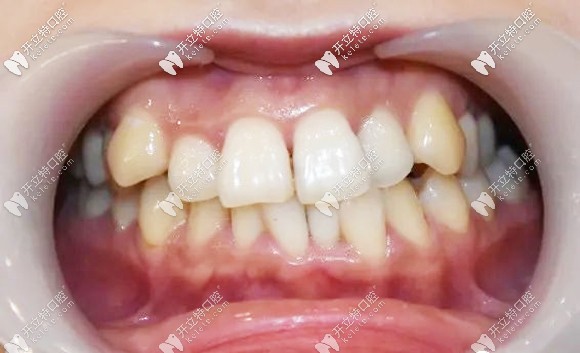 近距離的牙齒正面照