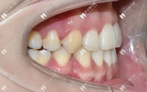矯正后的牙齒側面效果圖