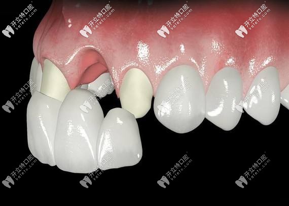 全瓷牙套的壽命是幾年?能用一輩子嗎？