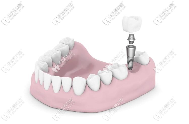 前牙種植和后牙種植的區(qū)別 前牙種植和后牙種植的區(qū)別