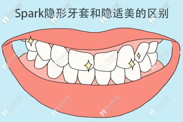 Spark隱形牙套和隱適美哪個(gè)好，區(qū)別是什么？