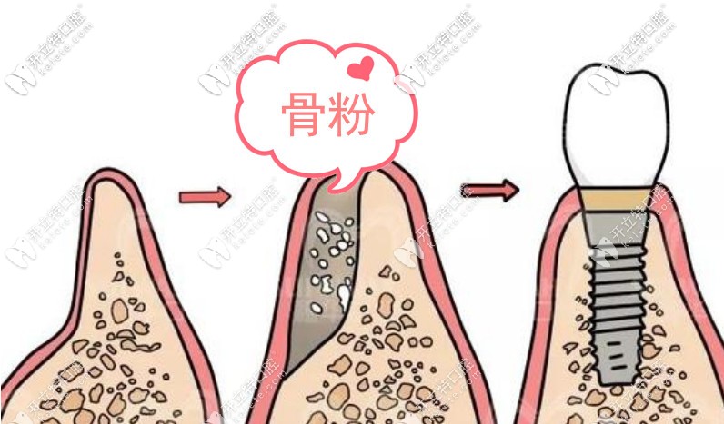 種植牙植骨粉疼嗎