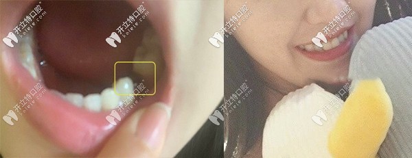 在昆明德韓口腔做韓系進(jìn)口種植牙的真實(shí)評(píng)價(jià)來了