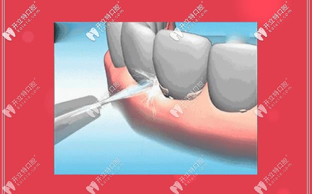 洗牙，給你牙齒干凈清爽