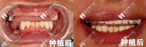 種植牙前后對(duì)比
