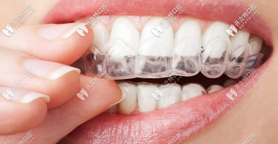 隱形矯正器 隱形矯正器