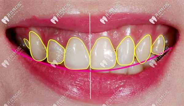 牙齒貼面的方案設(shè)計(jì)圖