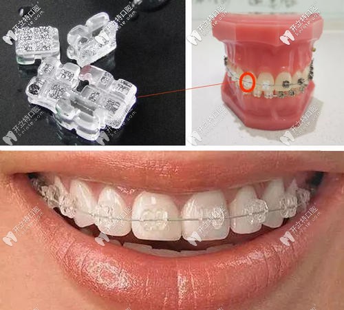 陶瓷單晶托槽外觀