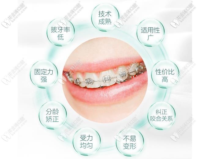 金屬托槽矯正優(yōu)點(diǎn)