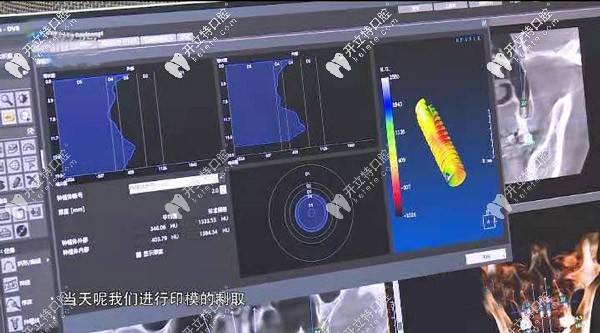 當天就可完成取模制作