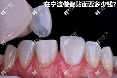 在寧波做瓷貼面的價格來咯