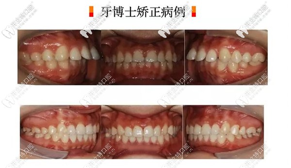 長春超龍牙博士口腔做瑞士進口隱形矯正案例 長春超龍牙博士口腔做瑞士進口隱形矯正案例