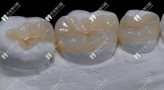 樹(shù)脂補(bǔ)牙的外觀