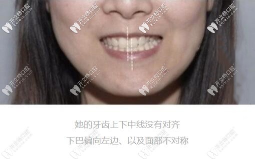 骨性偏頜一定要做正頜手術(shù)嗎?怎么判斷自己是骨性還是牙性