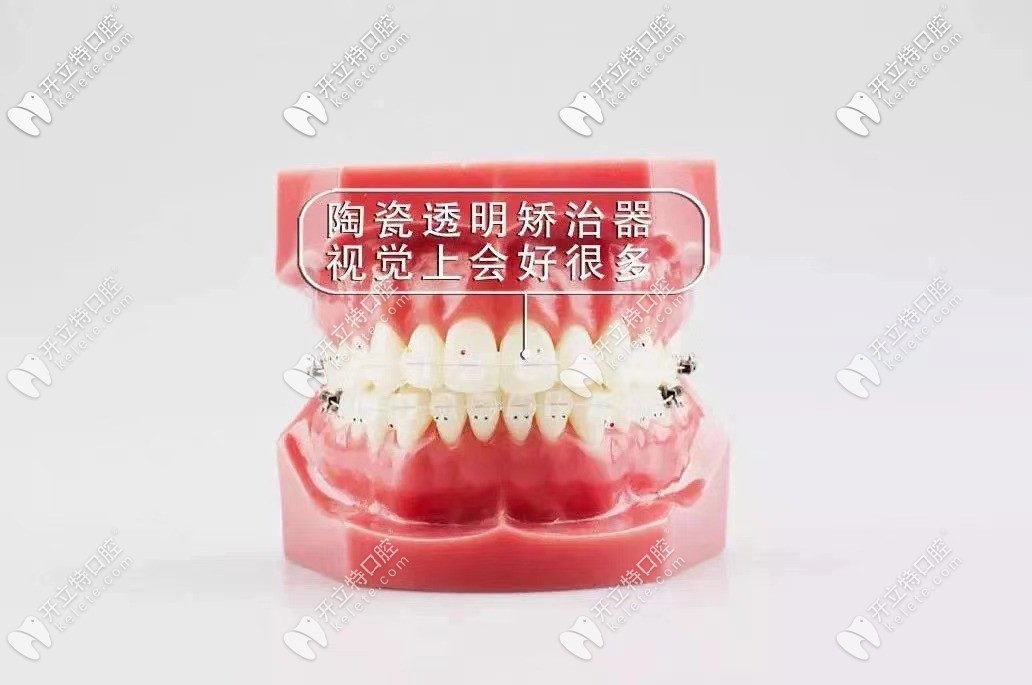 陶瓷半透明托槽的解說