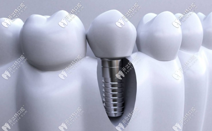 成都種植全口牙的價格是多少？附種牙醫(yī)生推薦！