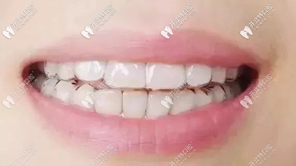 大同隱形牙套矯正的參考價格