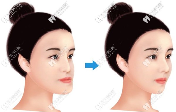 做正頜手術(shù)前后面部改善