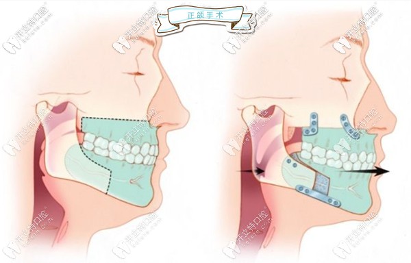 來聊聊我們廣州做正頜手術(shù)哪家醫(yī)院好且收費(fèi)還不太貴...