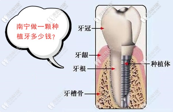 南寧做種植牙的價(jià)格是多少錢
