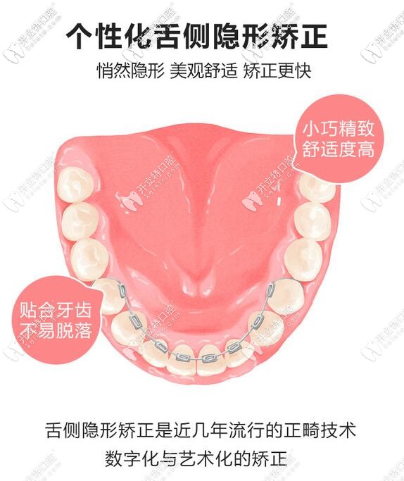 舌側(cè)隱形矯正的特點