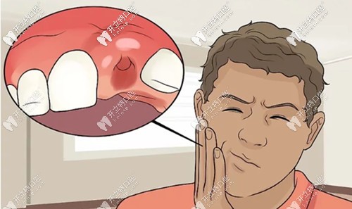 使用氯己定凝膠