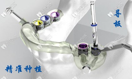 導(dǎo)板精準(zhǔn)種植