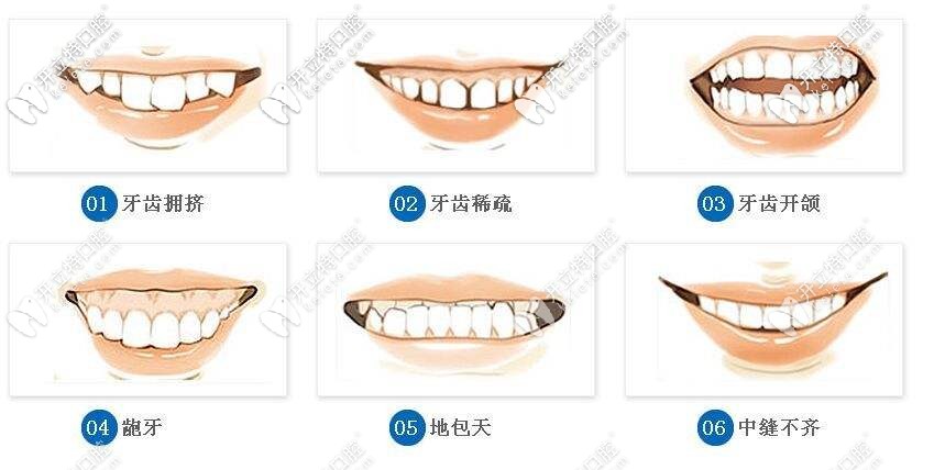 需要戴矯正器的癥狀