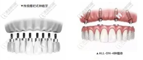 傳統(tǒng)點(diǎn)種和all-on-4種植的區(qū)別