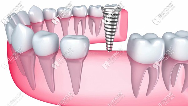 廣大口腔的德國(guó)和法國(guó)等種植牙價(jià)格